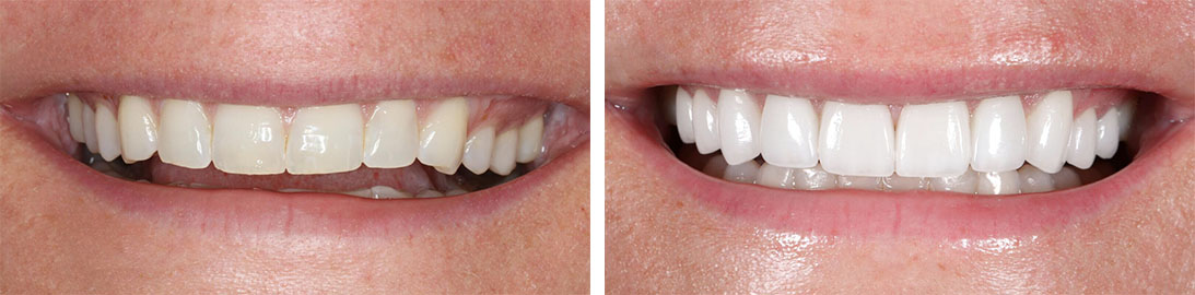 Smile of our patient