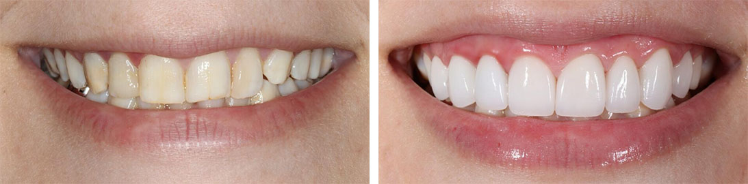 Smile of our patient