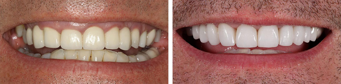 Smile of our patient