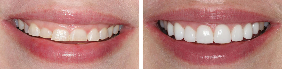 Smile of our patient