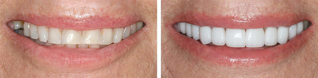 Smile of our patient