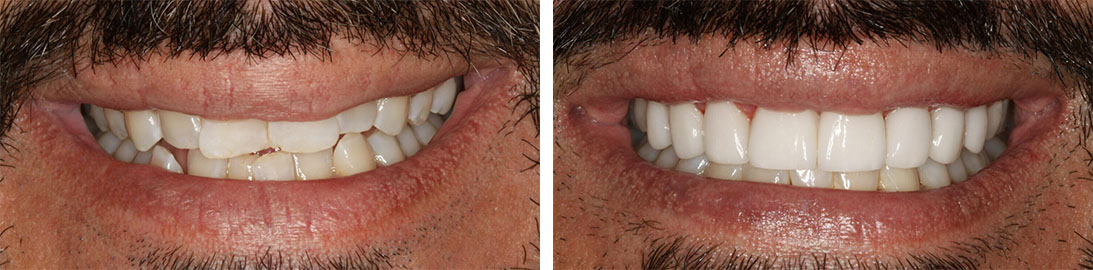 Smile of our patient