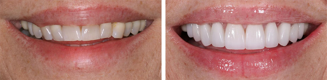 Smile of our patient