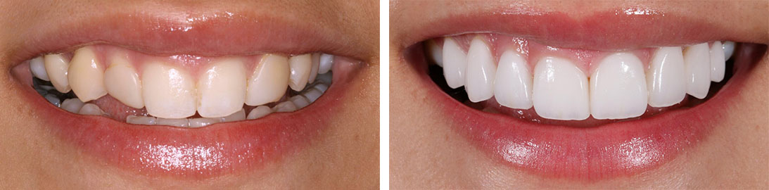 Smile of our patient