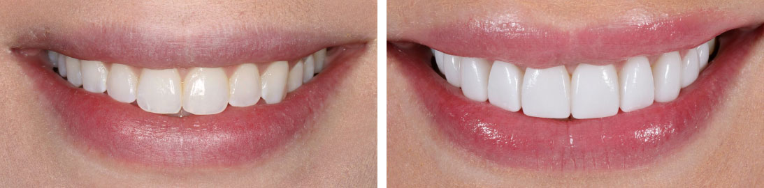 Smile of our patient