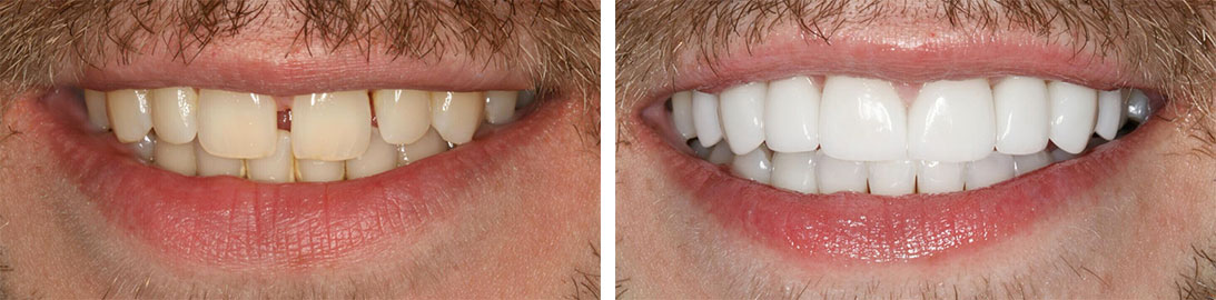 Smile of our patient