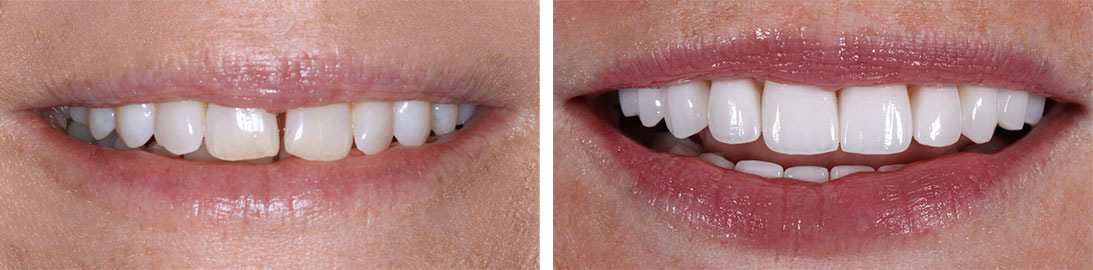 Smile of our patient