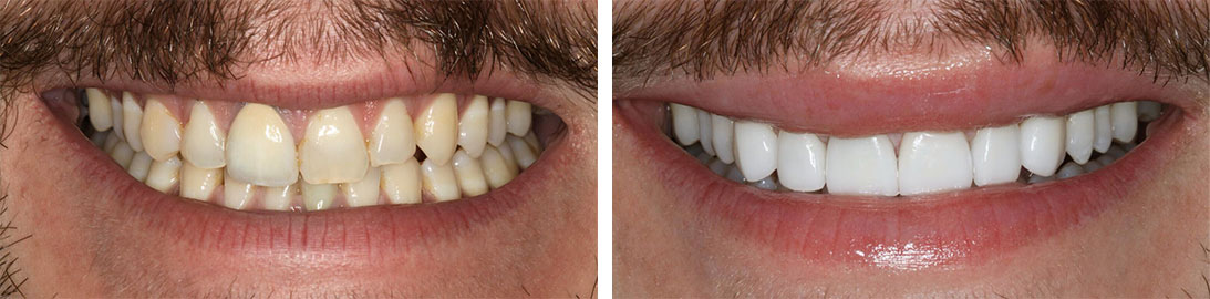 Smile of our patient