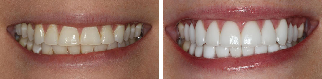 Smile of our patient