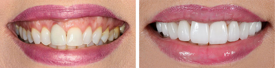 Smile of our patient