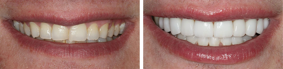 Smile of our patient