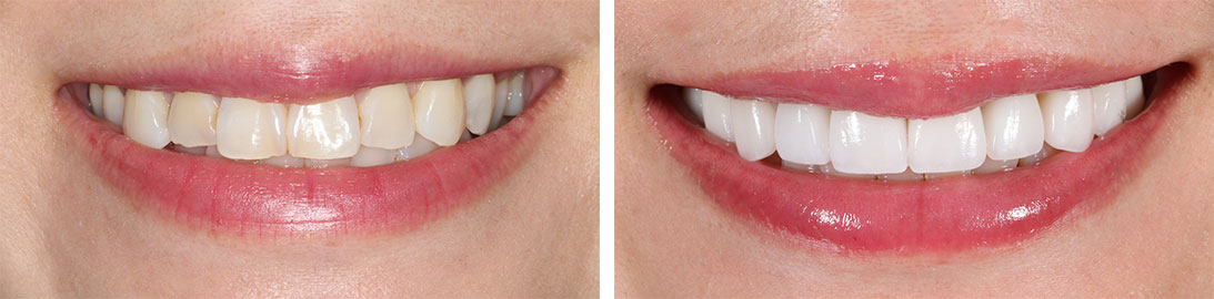 Smile of our patient