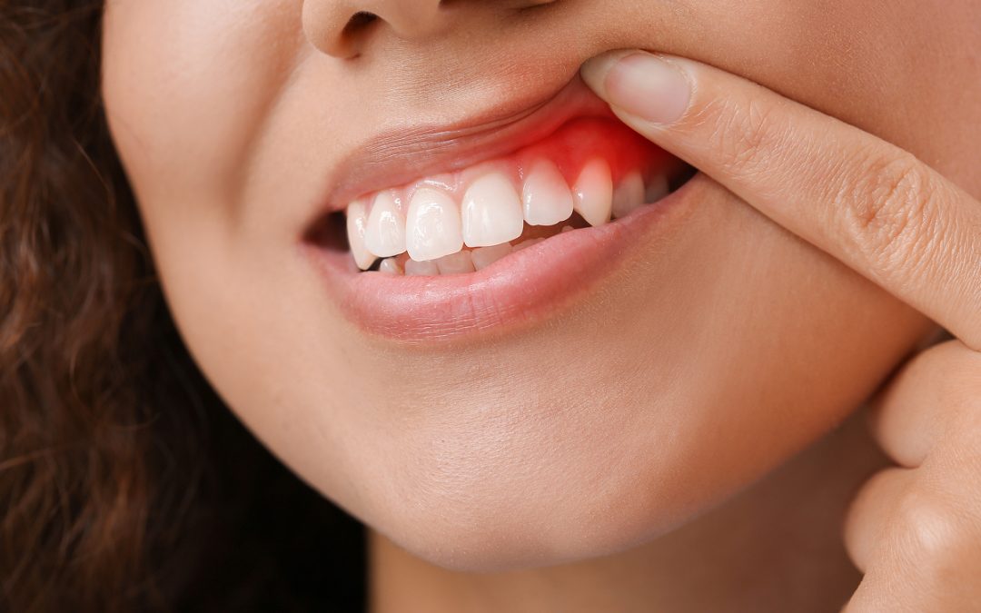 What Is Laser Gum Recontouring? A Modern Solution for a Gummy Smile